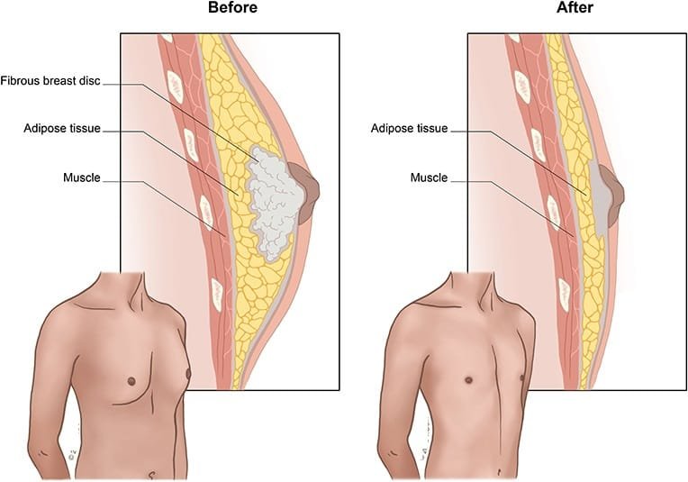 Gynecomastia in Patna